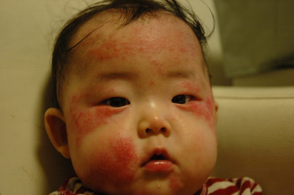 食物アレルギーの子どもと暮らす その2 始まりのアトピー性皮膚炎 Lee