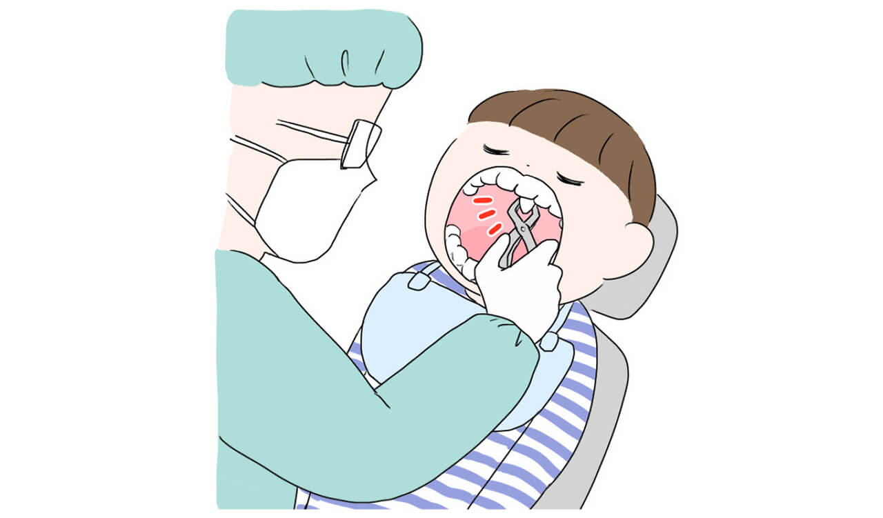 上あごの中心部に、鼻に向かって生えている“上顎正中過剰歯”があると言われました。放っておくと、これから出てくる永久歯の生え方にも影響があるということで、全身麻酔の手術で抜歯をすることに。
