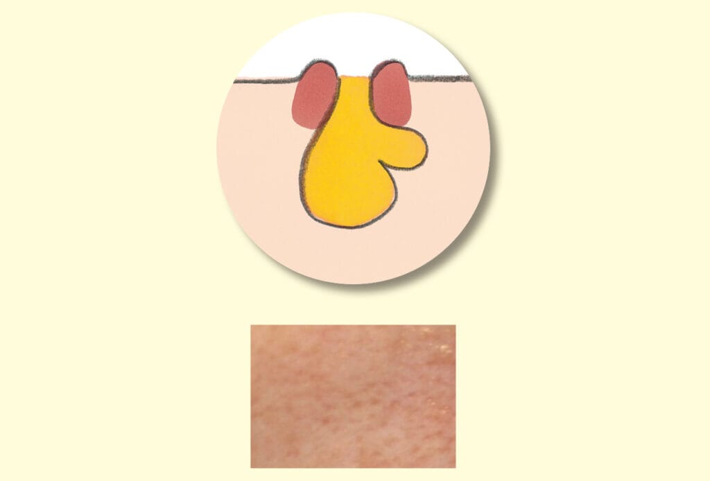 開き毛穴イラスト