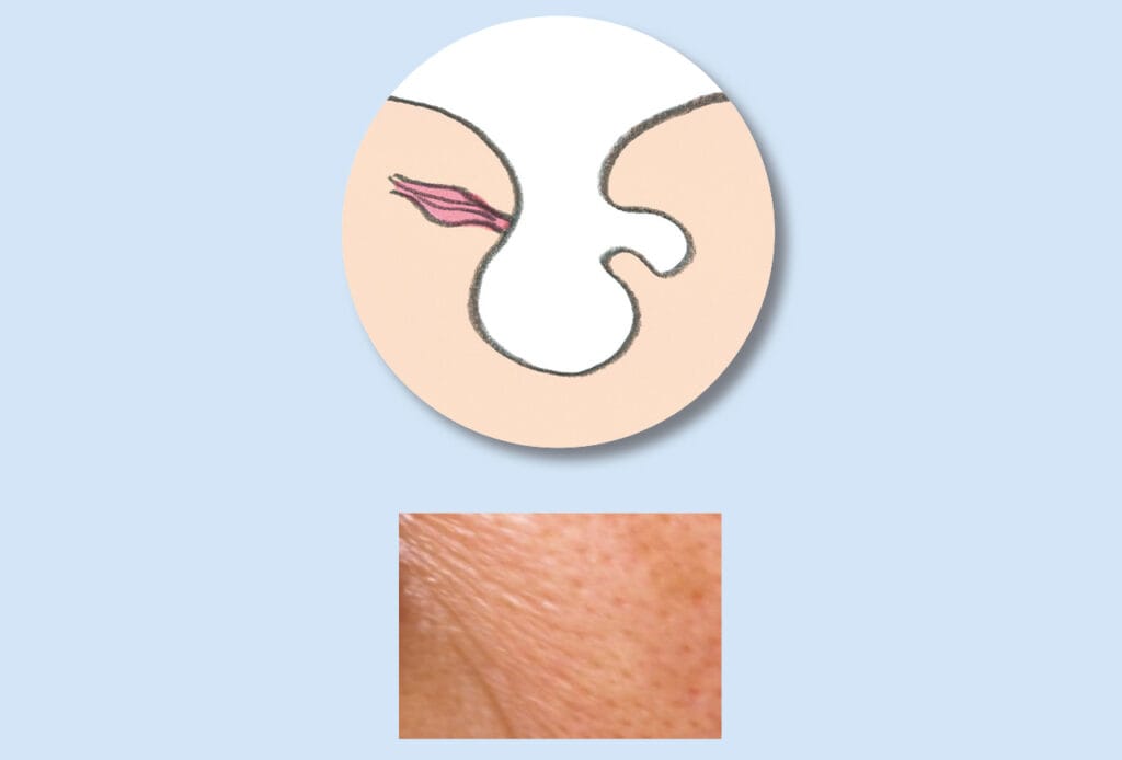 たるみ毛穴イラスト