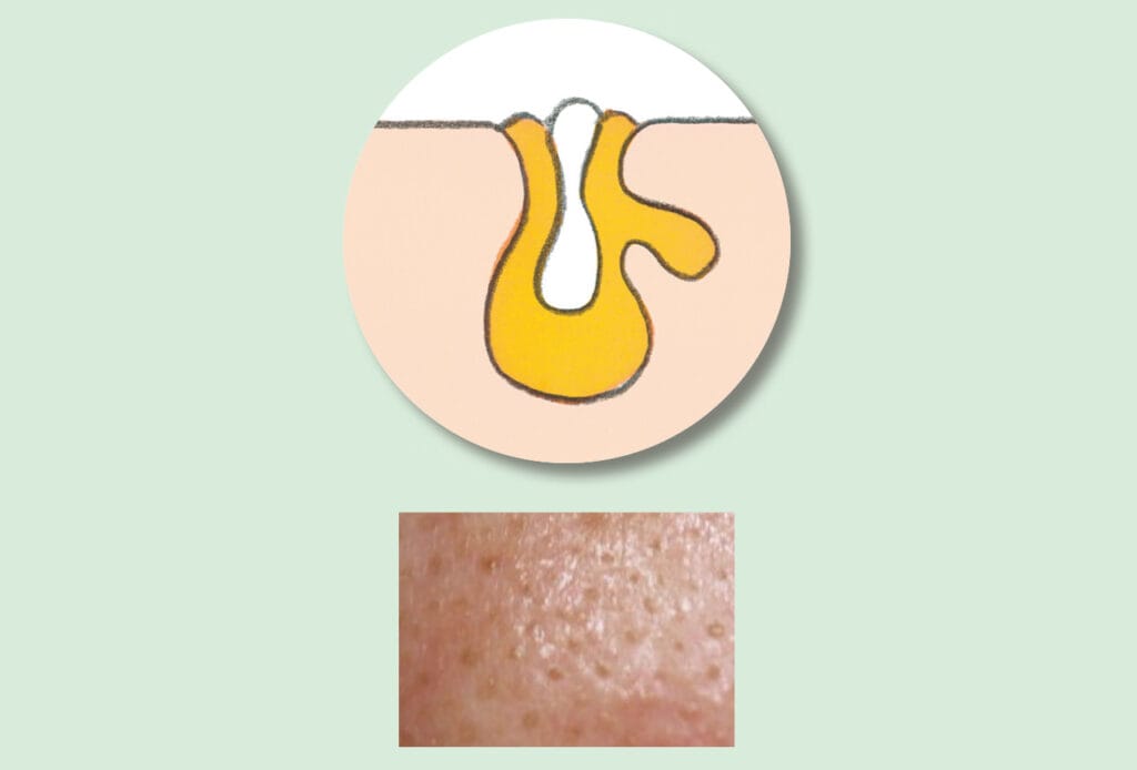 詰まり毛穴イラスト