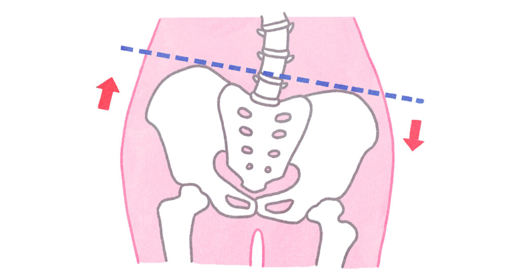 骨盤の左右ゆがみイラストカット