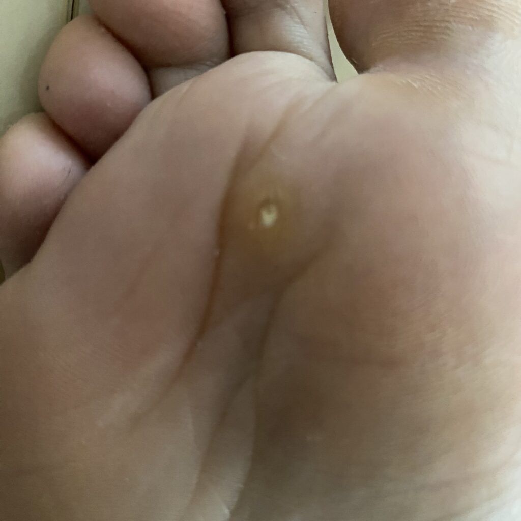 足　角質　魚の目