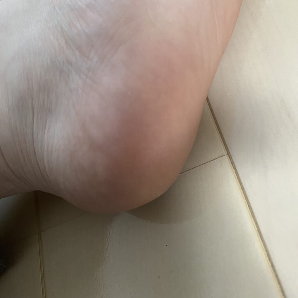 かかと　角質