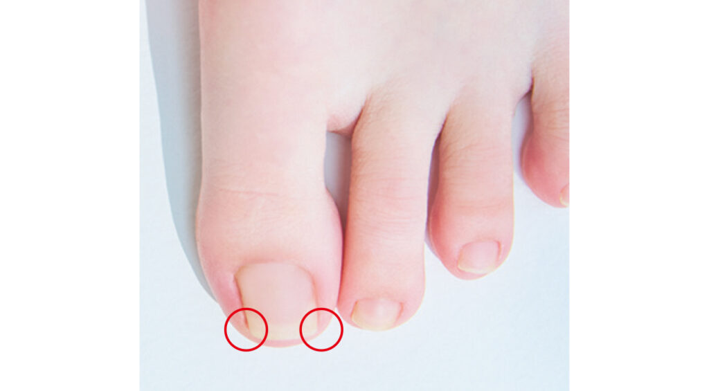 足の爪まわり
