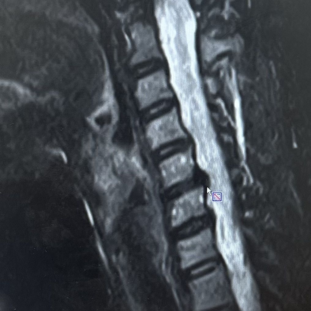 頚椎ヘルニア　MRI　 頚椎症