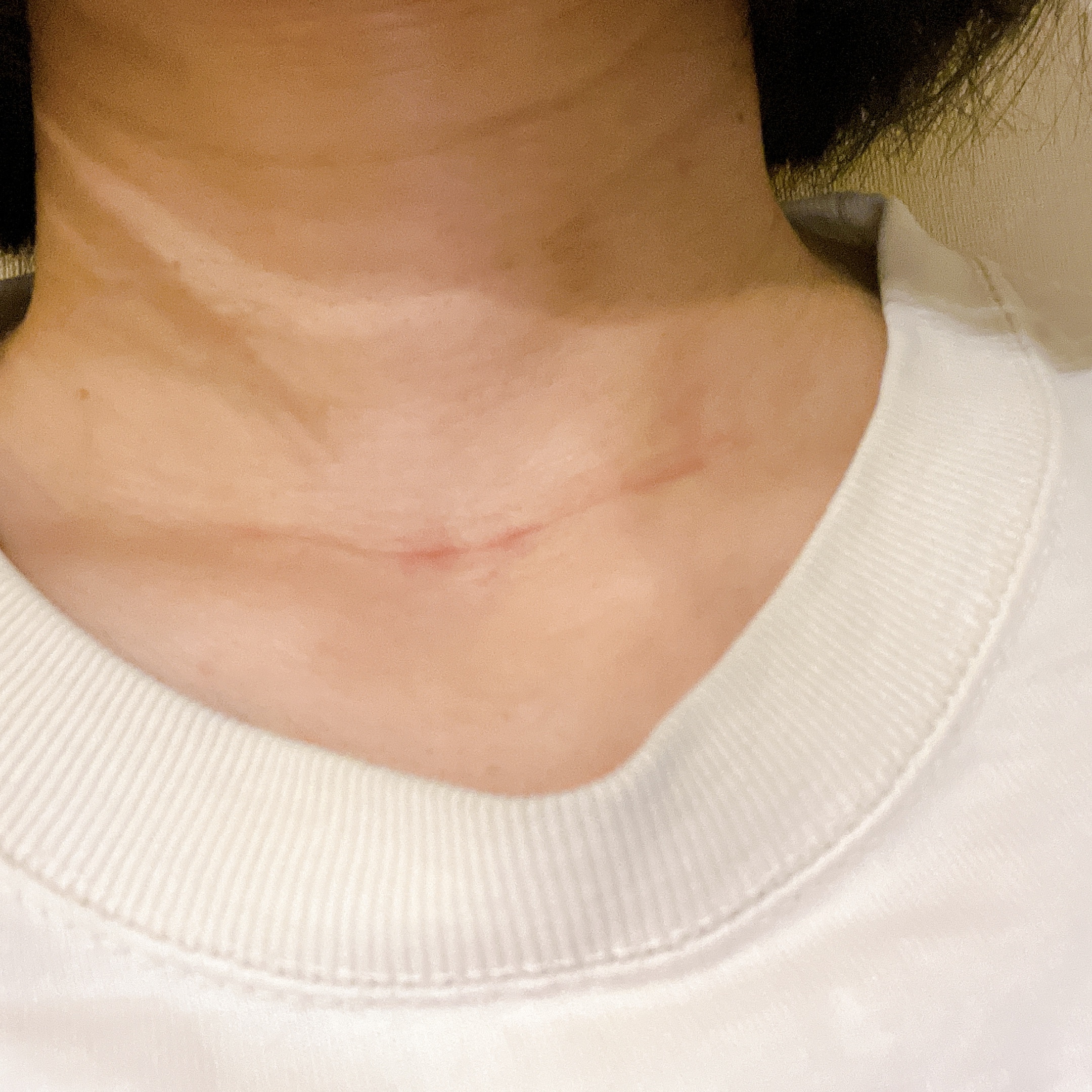 甲状腺乳頭癌術後3か月経過