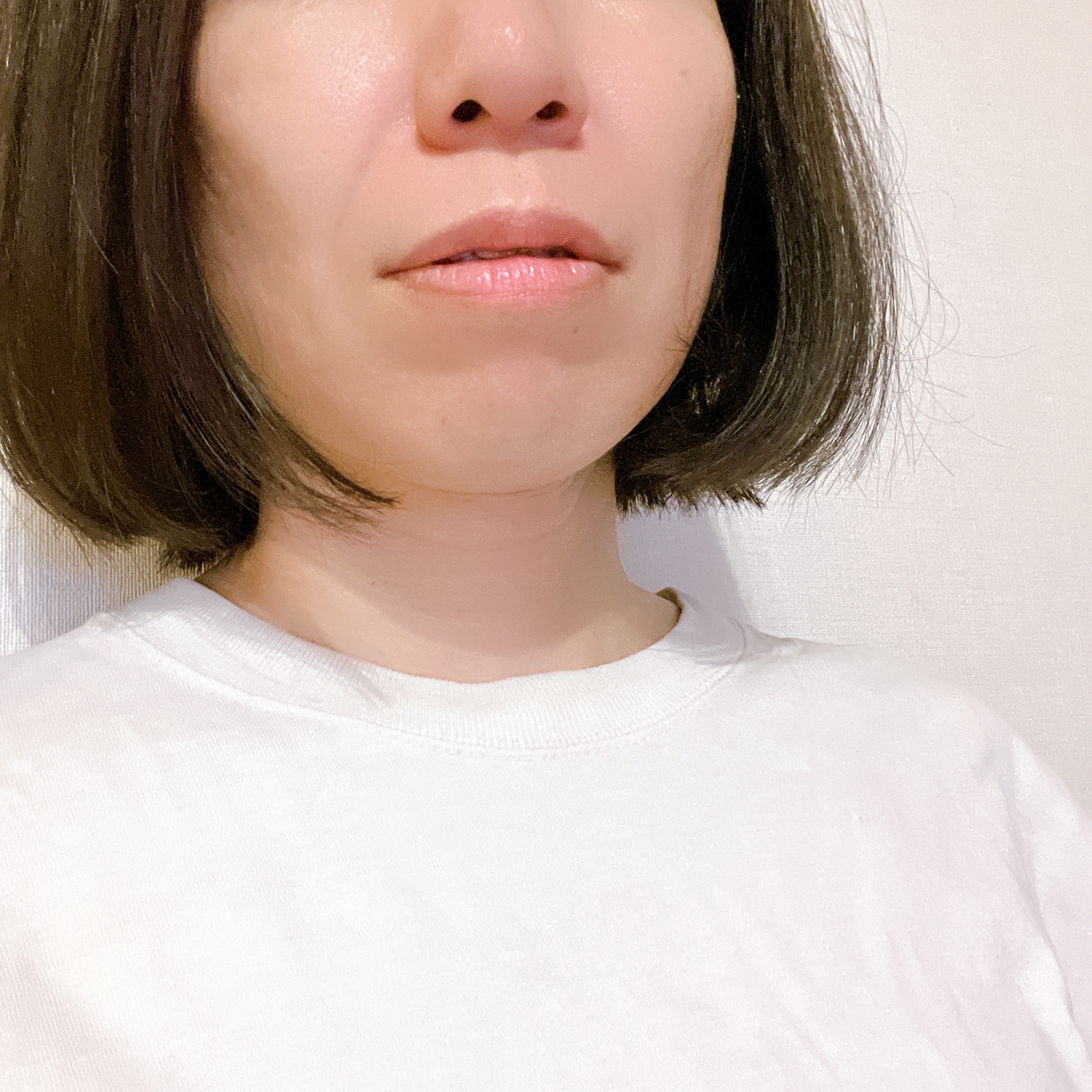 甲状腺乳頭癌術後3か月経過