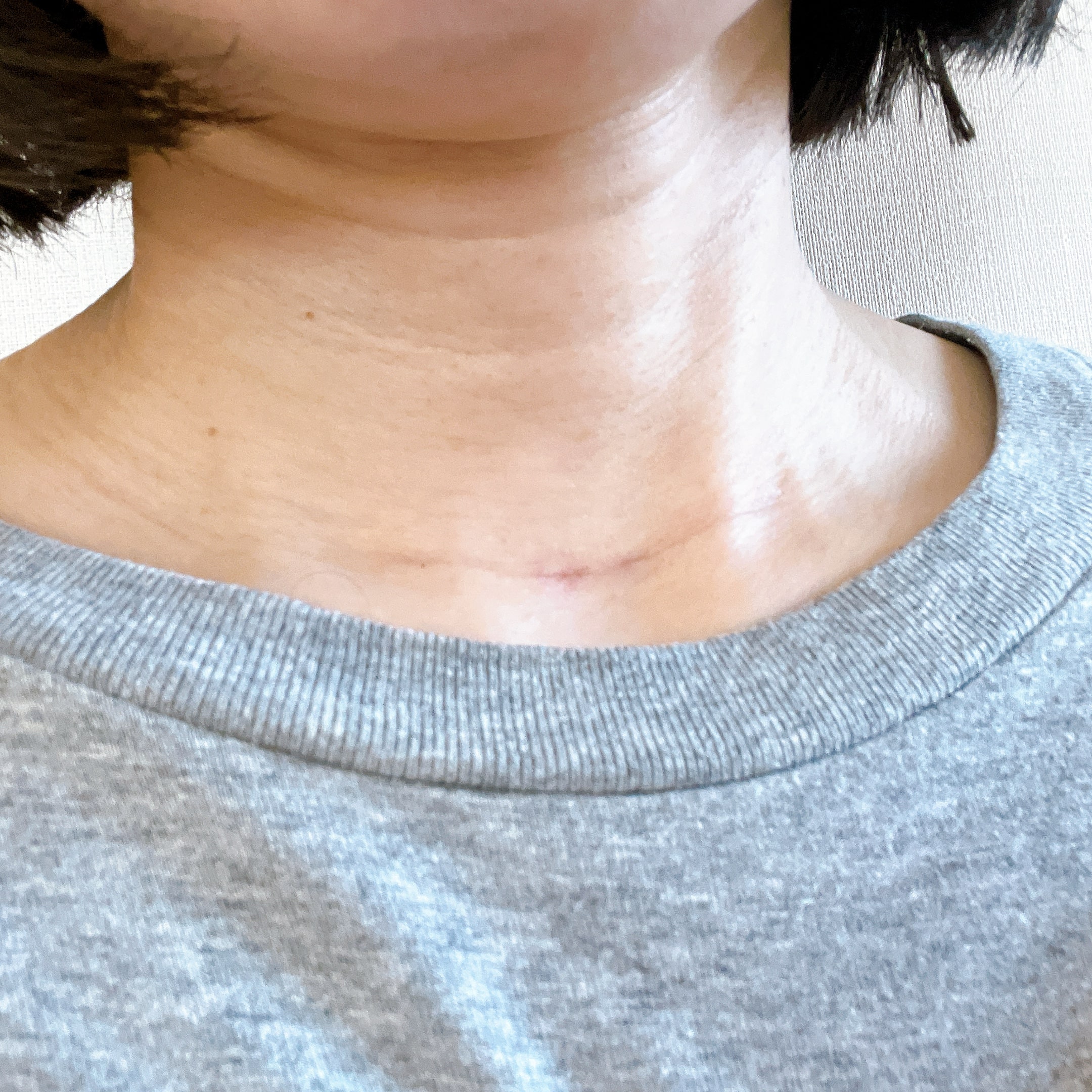 甲状腺乳頭癌術後3か月経過