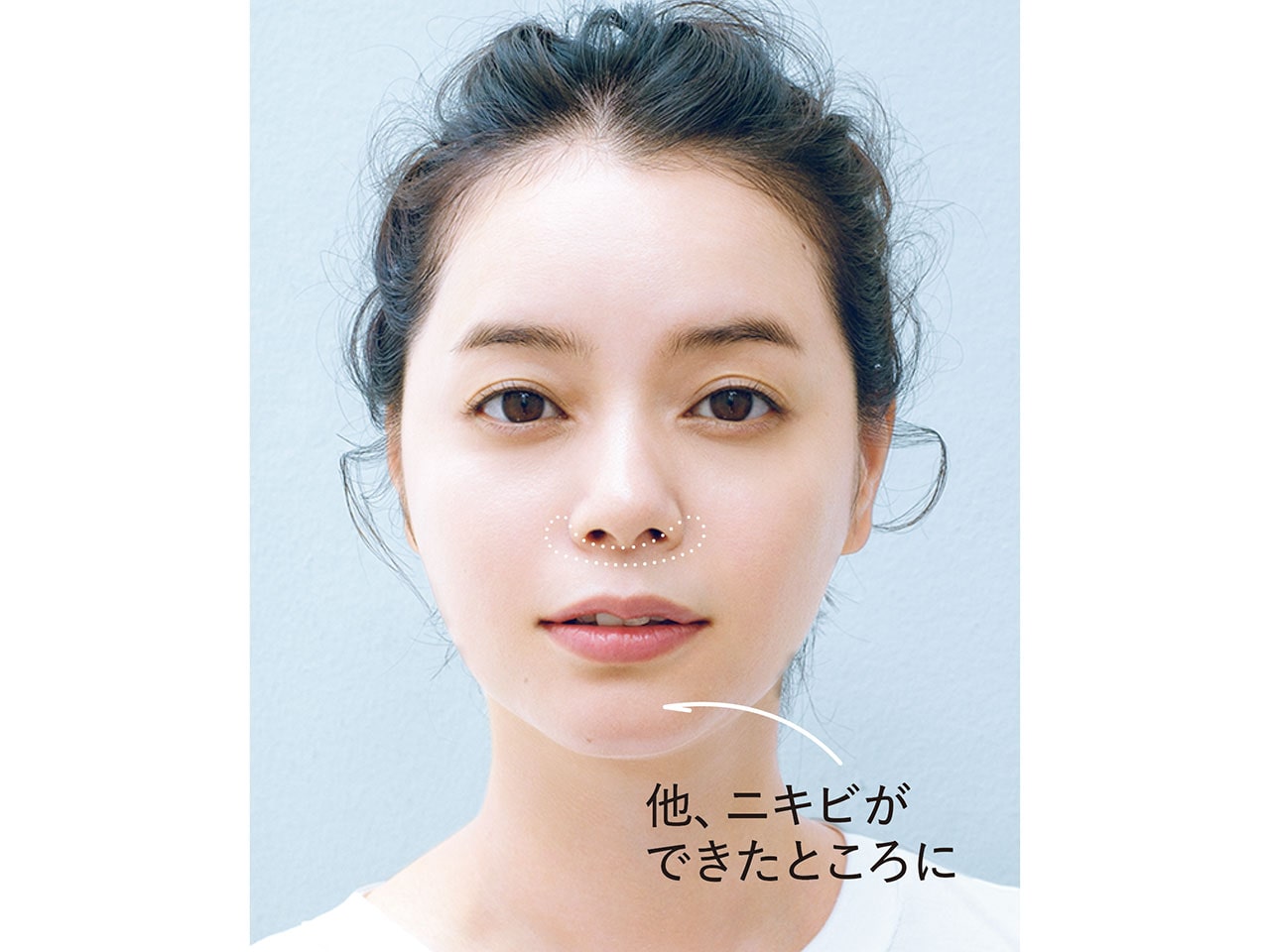 他、ニキビができたところに