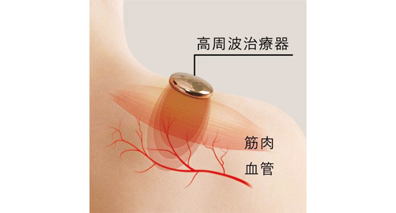 刺激のない高周波が、身体組織まで深く浸透。こりの患部に到着して血管を拡張させ、血行を促進。肩こりや腰こりなどの改善が期待できる。