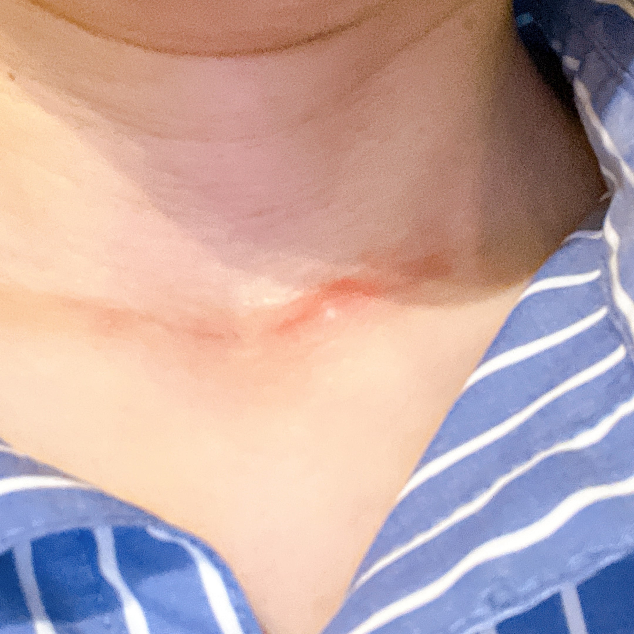 甲状腺乳頭癌術後5か月