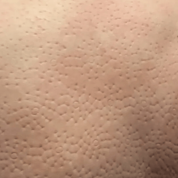 背中のスパイクの跡アップ