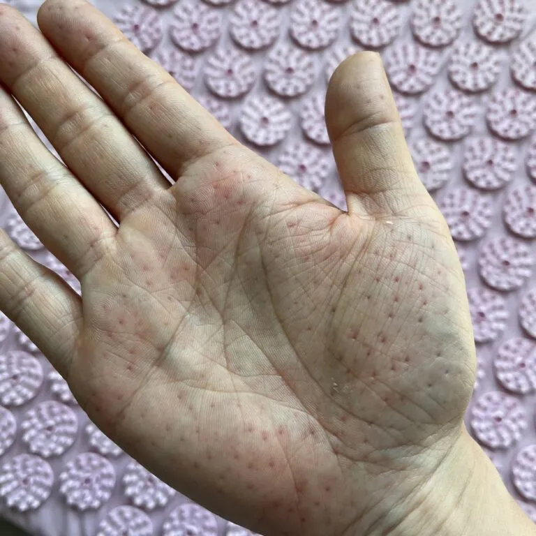 スパイクの跡がついた手