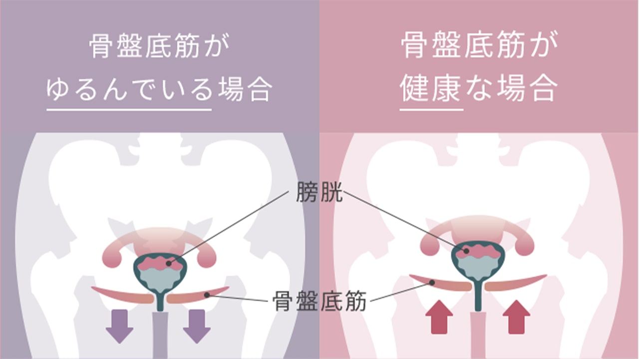 骨盤底筋がゆるんでいる場合と健康な場合の比較イラスト