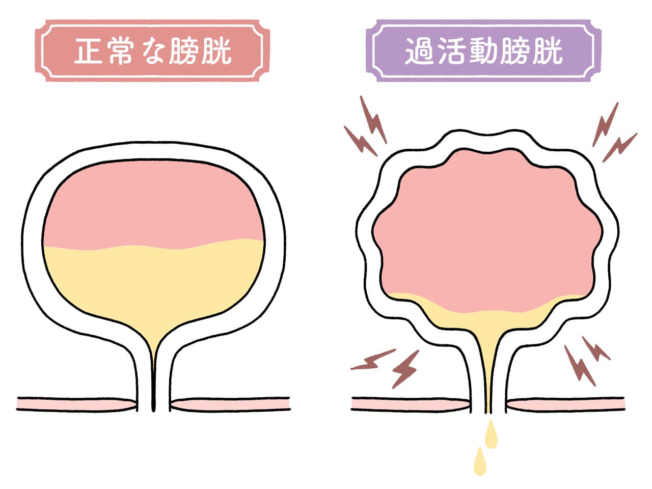 正常な膀胱と過活動膀胱の比較イメージ図。左側は尿が溜まっても安定している正常な膀胱、右側は膀胱で異常収縮が起こっている過活動膀胱の様子。