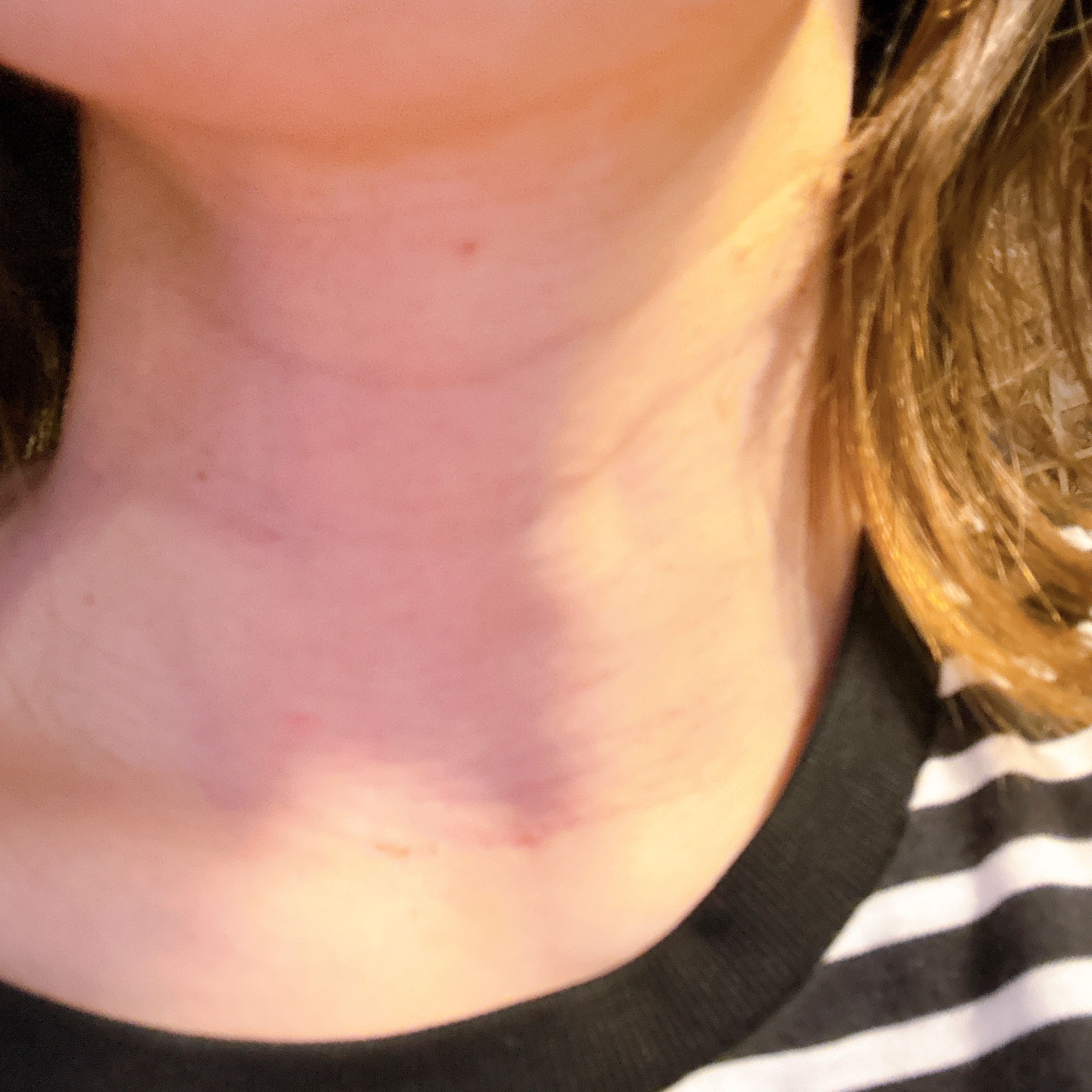 甲状腺乳頭がん術後9ヵ月傷跡