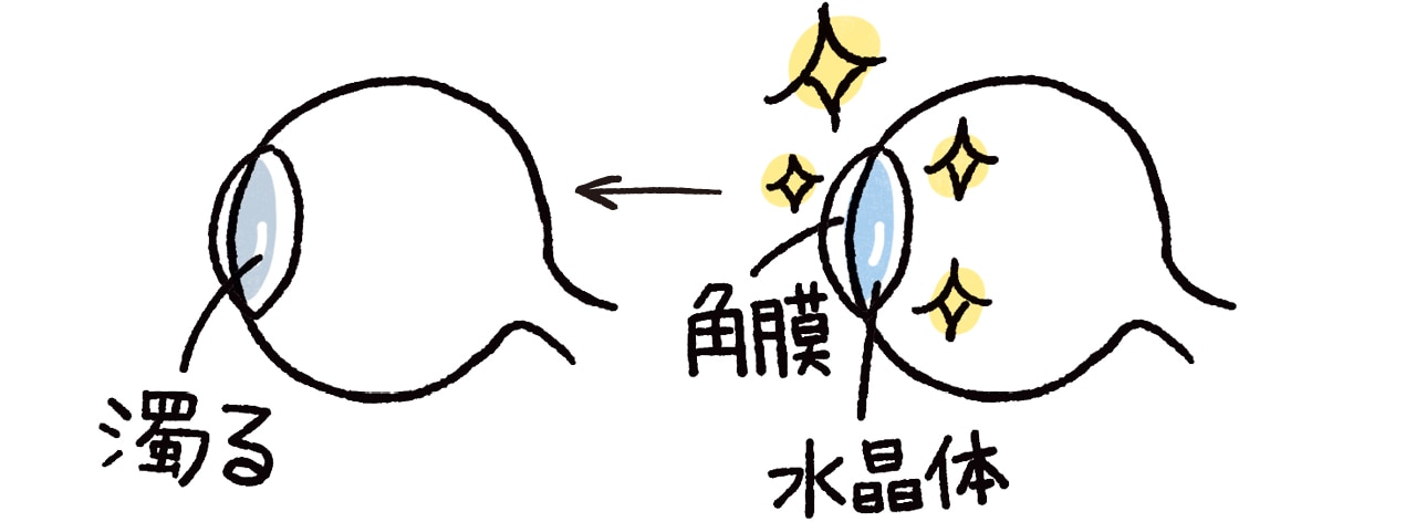 大量の紫外線を浴びると、本来透明な水晶体が濁り、将来的に「白内障」になる恐れが